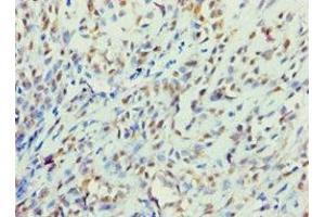Immunohistochemistry of paraffin-embedded human breast cancer using ABIN7145241 at dilution of 1:100 (BBS4 antibody  (AA 350-519))
