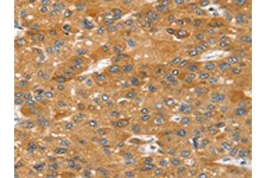 The image on the left is immunohistochemistry of paraffin-embedded Human liver cancer tissue using ABIN7192646(SRGAP2 Antibody) at dilution 1/20, on the right is treated with synthetic peptide.