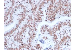 Formalin-fixed, paraffin-embedded human Colon Carcinoma stained with NRF1 Mouse Monoclonal Antibody (NRF1/2608). (NFE2L1 antibody)