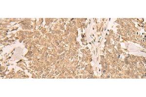 Immunohistochemistry of paraffin-embedded Human lung cancer tissue using IL1RAPL2 Polyclonal Antibody at dilution of 1:25(x200) (IL1RAPL2 antibody)