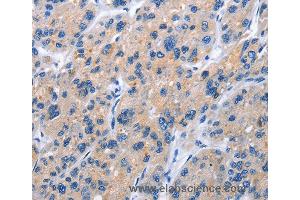 Immunohistochemistry of Human gastric cancer using TNFRSF9 Polyclonal Antibody at dilution of 1:40