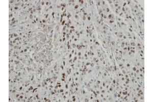 IHC-P Image Immunohistochemical analysis of paraffin-embedded Mahlavu xenograft, using COPS2, antibody at 1:100 dilution. (COPS2 antibody  (C-Term))