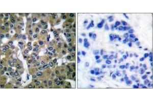 Immunohistochemistry analysis of paraffin-embedded human breast carcinoma tissue, using PLCG2 (Ab-753) Antibody.