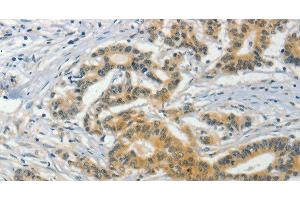 Immunohistochemistry of paraffin-embedded Human colon cancer tissue using ASB8 Polyclonal Antibody at dilution 1:50 (ASB8 antibody)