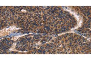 Immunohistochemistry of paraffin-embedded Human liver cancer using CD61 Polyclonal Antibody at dilution of 1:30 (Integrin beta 3 antibody)