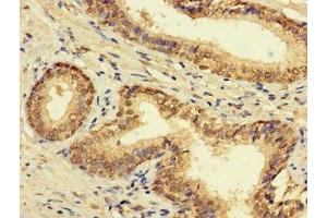 Immunohistochemistry of paraffin-embedded human prostate cancer using ABIN7165398 at dilution of 1:100 (FAM135B antibody  (AA 801-1100))