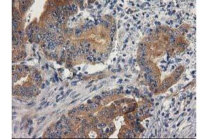 Immunohistochemical staining of paraffin-embedded Adenocarcinoma of Human colon tissue using anti-BCAR1 mouse monoclonal antibody. (BCAR1 antibody)