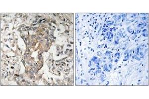Immunohistochemistry analysis of paraffin-embedded human breast carcinoma tissue, using SPHK2 (Ab-614) Antibody. (SPHK2 antibody  (AA 580-629))