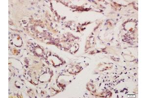 Formalin-fixed and paraffin embedded human breast cancer labeled with Rabbit Anti-GnRHR Polyclonal Antibody, Unconjugated  at 1:200, followed by conjugation to the secondary antibody and DAB staining (GNRHR antibody  (AA 201-328))