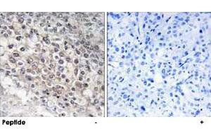 Immunohistochemistry analysis of paraffin-embedded human liver carcinoma tissue using CYP2W1 polyclonal antibody . (CYP2W1 antibody)