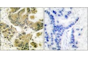 Immunohistochemistry analysis of paraffin-embedded human breast carcinoma tissue, using SGK (Ab-422) Antibody. (SGK1 antibody  (AA 381-430))