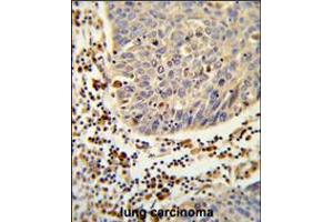 Formalin-fixed and paraffin-embedded human lung carcinoma reacted with SH2D1B Antibody , which was peroxidase-conjugated to the secondary antibody, followed by DAB staining. (SH2D1B antibody  (AA 65-92))
