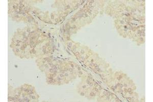 Immunohistochemistry of paraffin-embedded human prostate cancer using ABIN7171939 at dilution of 1:100 (TTC38 antibody  (AA 2-200))