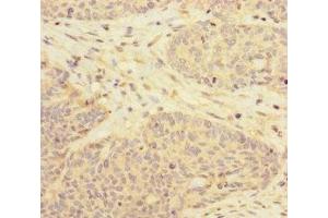 Immunohistochemistry of paraffin-embedded human ovarian cancer using ABIN7170629 at dilution of 1:100