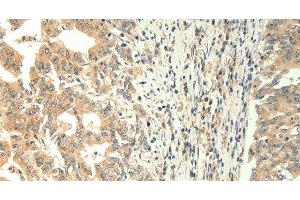 Immunohistochemistry of paraffin-embedded Human gastric cancer using TRPM5 Polyclonal Antibody at dilution of 1:60 (TRPM5 antibody)