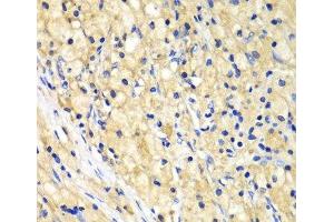 Immunohistochemistry of paraffin-embedded Human lung cancer using NUP62 Polyclonal Antibody at dilution of 1:100 (40x lens). (NUP62 antibody)