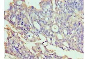 Immunohistochemistry of paraffin-embedded human endometrial cancer using ABIN7172022 at dilution of 1:100 (TXNRD2 antibody  (AA 100-310))