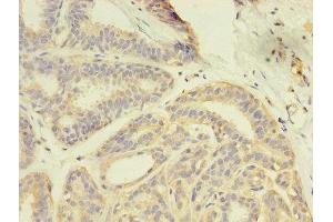 Immunohistochemistry of paraffin-embedded human breast cancer using ABIN7166957 at dilution of 1:100 (GDI2 antibody  (AA 1-445))