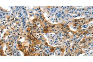 Immunohistochemistry of paraffin-embedded Human lung cancer tissue using COG1 Polyclonal Antibody at dilution 1:60 (COG1 antibody)
