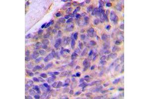 Immunohistochemical analysis of Galectin 8 staining in human breast cancer formalin fixed paraffin embedded tissue section. (LGALS8 antibody  (Center))