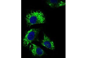 Immunohistochemical analysis of paraffin-embedded bladder cancer tissues using IL2RA antibody with DAB staining. (CD25 antibody  (AA 34-139))