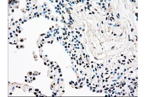 Immunohistochemical staining of paraffin-embedded Adenocarcinoma of breast tissue using anti-RAD9A mouse monoclonal antibody. (RAD9A antibody)