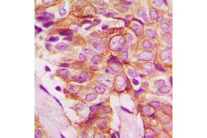 Immunohistochemical analysis of Frizzled 8 staining in human breast cancer formalin fixed paraffin embedded tissue section. (FZD8 antibody  (C-Term))