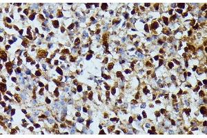 Immunohistochemistry of paraffin-embedded Human appendix using DUT Polyclonal Antibody at dilution of 1:100 (40x lens). (Deoxyuridine Triphosphatase (DUT) antibody)