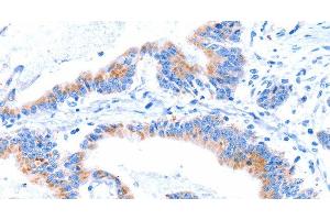 Immunohistochemistry of paraffin-embedded Human colon cancer tissue using SMG8 Polyclonal Antibody at dilution 1:50 (SMG8 antibody)