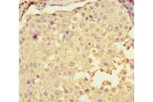 Immunohistochemistry of paraffin-embedded human breast cancer using ABIN7148515 at dilution of 1:100 (Copine II antibody  (AA 1-300))