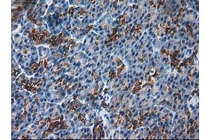 Immunohistochemical staining of paraffin-embedded Adenocarcinoma of colon using anti-KRT18 (ABIN2452646) mouse monoclonal antibody.