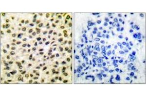 Immunohistochemistry analysis of paraffin-embedded human breast carcinoma tissue, using Fos Antibody. (c-FOS antibody  (AA 1-50))