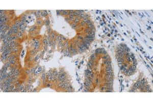 Immunohistochemistry of paraffin-embedded Human colon cancer using F2R Polyclonal Antibody at dilution of 1:40 (PAR1 antibody)