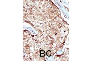 Formalin-fixed and paraffin-embedded human cancer tissue reacted with the primary antibody, which was peroxidase-conjugated to the secondary antibody, followed by AEC staining. (PAPSS2 antibody  (C-Term))