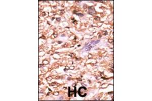 Formalin-fixed and paraffin-embedded human cancer tissue reacted with the primary antibody, which was peroxidase-conjugated to the secondary antibody, followed by AEC staining. (p53 antibody  (pThr18))