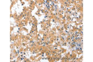 Immunohistochemistry of Human liver cancer using CDR2 Polyclonal Antibody at dilution of 1:60 (CDR2 antibody)