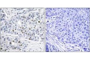 Immunohistochemistry analysis of paraffin-embedded human breast carcinoma tissue, using Retinoblastoma (Ab-821) Antibody. (Retinoblastoma Protein (Rb) antibody  (AA 791-840))