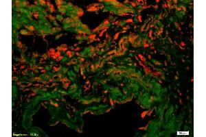 Formalin-fixed and paraffin-embedded human colon carcinoma labeled with Anti-VE Cadherin/VECD/CD144 Polyclonal Antibody, Unconjugated (ABIN1387250) 1:200, overnight at 4°C, The secondary antibody was Goat Anti-Rabbit IgG, Cy3 conjugated used at 1:200 dilution for 40 minutes at 37°C. (Cadherin 5 antibody  (AA 251-320))