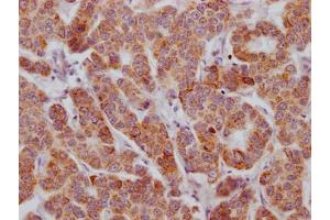 IHC image of ABIN7127321 diluted at 1:100 and staining in paraffin-embedded human breast cancer performed on a Leica BondTM system. (Recombinant ACVR2B antibody)