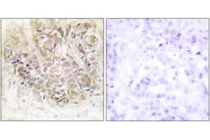 Immunohistochemistry analysis of paraffin-embedded human breast carcinoma tissue, using TCTP Antibody.