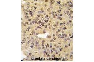Formalin-fixed and paraffin-embedded human prostata carcinoma tissue reacted with MEN1 Antibody  (ABIN391613 and ABIN2841534) , which was peroxidase-conjugated to the secondary antibody, followed by DAB staining. (Menin antibody  (AA 113-144))