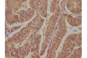 IHC image of ABIN7152176 diluted at 1:100 and staining in paraffin-embedded human endometrial cancer performed on a Leica BondTM system. (EIF4G2 antibody  (AA 706-907))