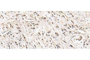 Immunohistochemistry of paraffin-embedded Human prost ate cancer tissue using ZNF281 Polyclonal Antibody at dilution of 1:30(x200)