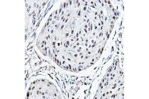 Immunohistochemistry of paraffin-embedded human esophageal cancer using MDC1 Rabbit pAb (ABIN6134688, ABIN6143659, ABIN6143661 and ABIN6216452) at dilution of 1:150 (40x lens). (MDC1 antibody  (AA 1-100))
