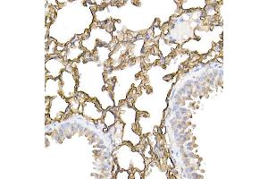 Immunohistochemistry of paraffin-embedded human lung cancer using ICAM-1/CD54 Rabbit pAb (ABIN6129231, ABIN6142118, ABIN6142120 and ABIN6221235) at dilution of 1:100 (40x lens). (ICAM1 antibody  (AA 250-480))