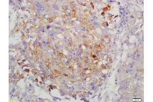 Formalin-fixed and paraffin embedded human lung carcinoma labeled with Anti-LMP7 Polyclonal Antibody, Unconjugated  at 1:200 followed by conjugation to the secondary antibody and DAB staining. (PSMB8 antibody  (AA 171-272))