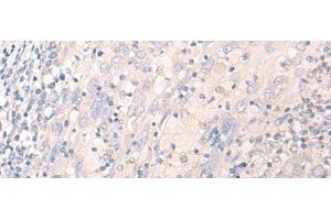 Immunohistochemistry of paraffin-embedded Human cervical cancer tissue using LILRA2 Polyclonal Antibody at dilution of 1:40(x200) (LILRA2 antibody)