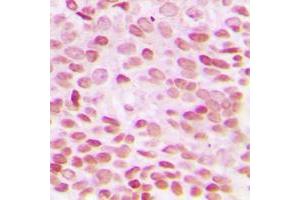 Immunohistochemical analysis of GADD153 staining in human breast cancer formalin fixed paraffin embedded tissue section. (DDIT3 antibody  (N-Term))
