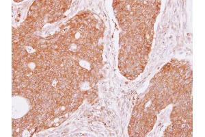 IHC-P Image DIAPH1 antibody [C2C3], C-term detects DIAPH1 protein at cytoplasm on human colon carcinoma by immunohistochemical analysis. (DIAPH1 antibody  (C-Term))