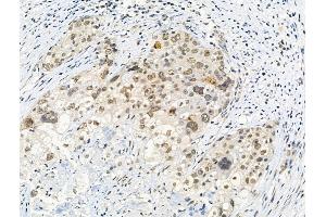 Phospho-Histone H3 (Thr3) Antibody at 1/100 staining Human ovarian cancer by IHC-P. (Histone 3 antibody  (H3T3ph))
